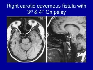 Right carotid cavernous fistula with
3rd
& 4th
Cn palsy
 