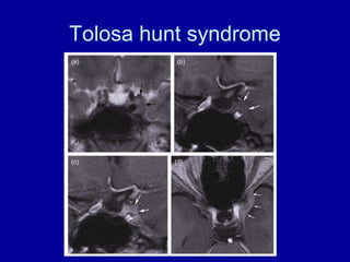 Tolosa hunt syndrome
 