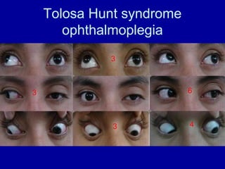 Tolosa Hunt syndrome
ophthalmoplegia
3
3
3
4
6
 