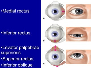 •Medial rectus
•Inferior rectus
•Levator palpebrae
superioris
•Superior rectus
•Inferior oblique
 