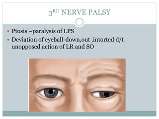 3RD NERVE PALSY
 Ptosis –paralysis of LPS
 Deviation of eyeball-down,out ,intorted d/t
unopposed action of LR and SO
 