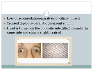  Loss of accomodation-paralysis of ciliary muscle
 Crossed diplopia-paralytic divergent squint
 Head is turned on the opposite side,tilted towards the
same side and chin is slightly raised
 
