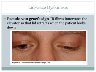 Lid-Gaze Dyskinesis
 Pseudo von graefe sign-IR fibres innervates the
elevator so that lid retracts when the patient looks
down
 