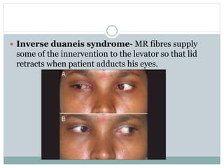  Inverse duaneis syndrome- MR fibres supply
some of the innervention to the levator so that lid
retracts when patient adducts his eyes.
 