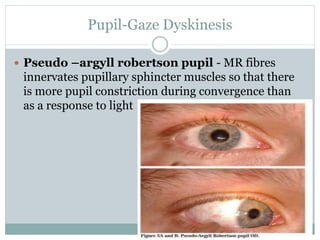 Pupil-Gaze Dyskinesis
 Pseudo –argyll robertson pupil - MR fibres
innervates pupillary sphincter muscles so that there
is more pupil constriction during convergence than
as a response to light
 