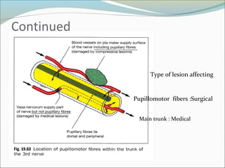 Continued
Type of lesion affecting
Pupillomotor fibers :Surgical
Main trunk : Medical
 