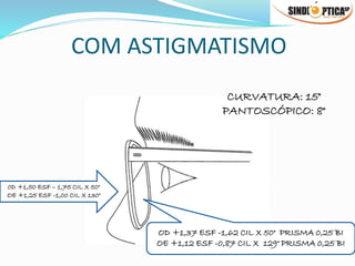 COM ASTIGMATISMO
0D +1,50 ESF – 1,75 CIL X 50°
OE +1,25 ESF -1,00 CIL X 130°
OD +1,37 ESF -1,62 CIL X 50° PRISMA 0,25 BI
OE +1,12 ESF -0,87 CIL X 129° PRISMA 0,25 BI
CURVATURA: 15°
PANTOSCÓPICO: 8°
 