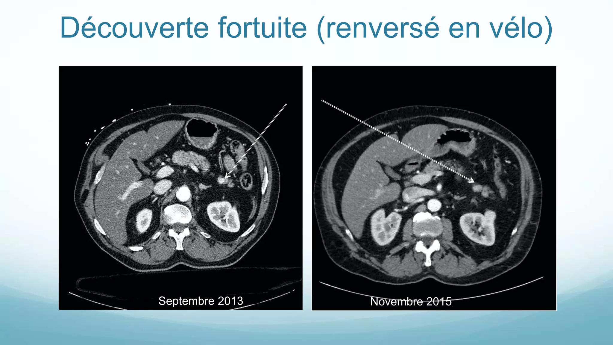Découverte fortuite (renversé en vélo)
Septembre 2013 Novembre 2015
 