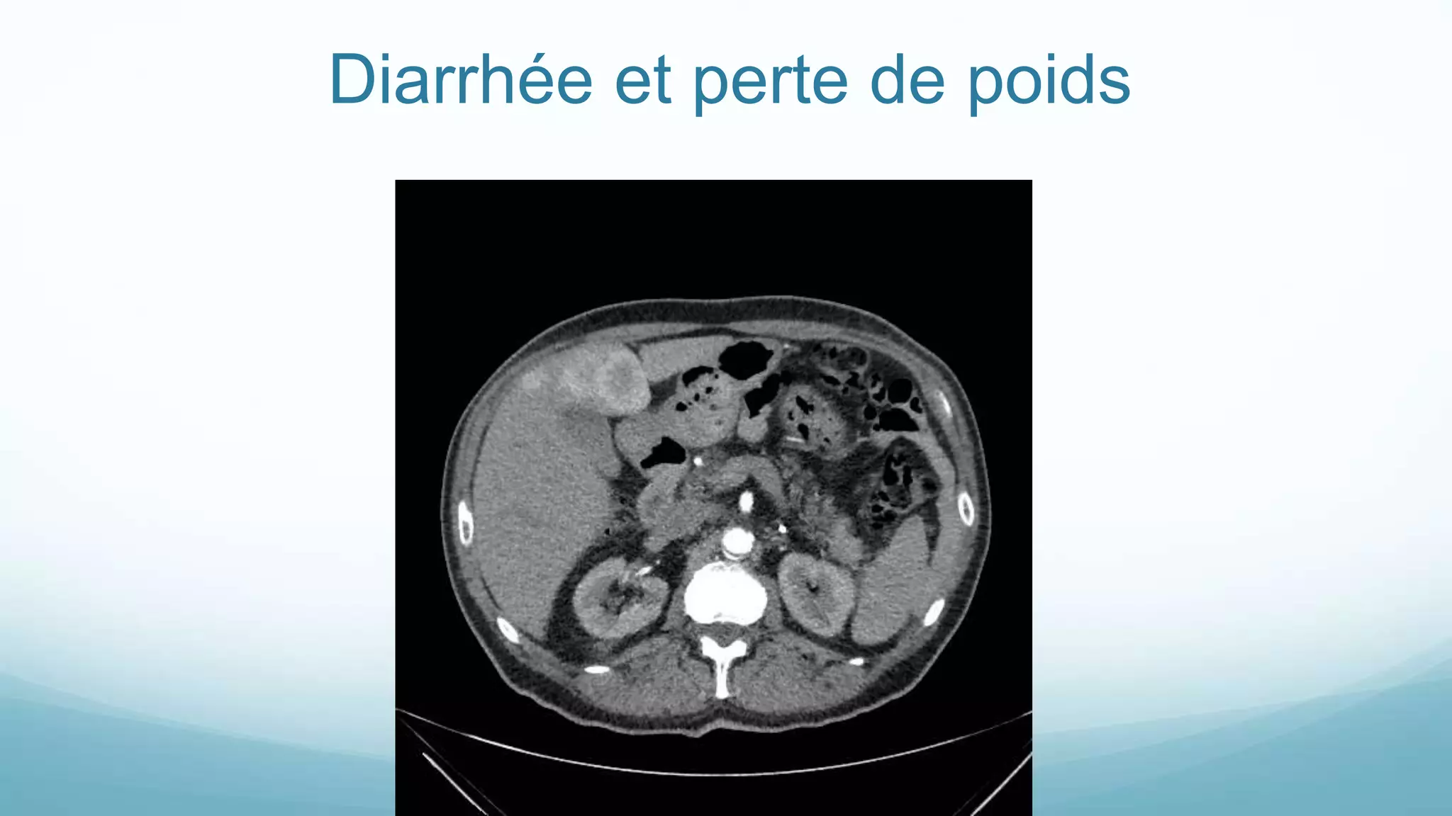 Diarrhée et perte de poids
 
