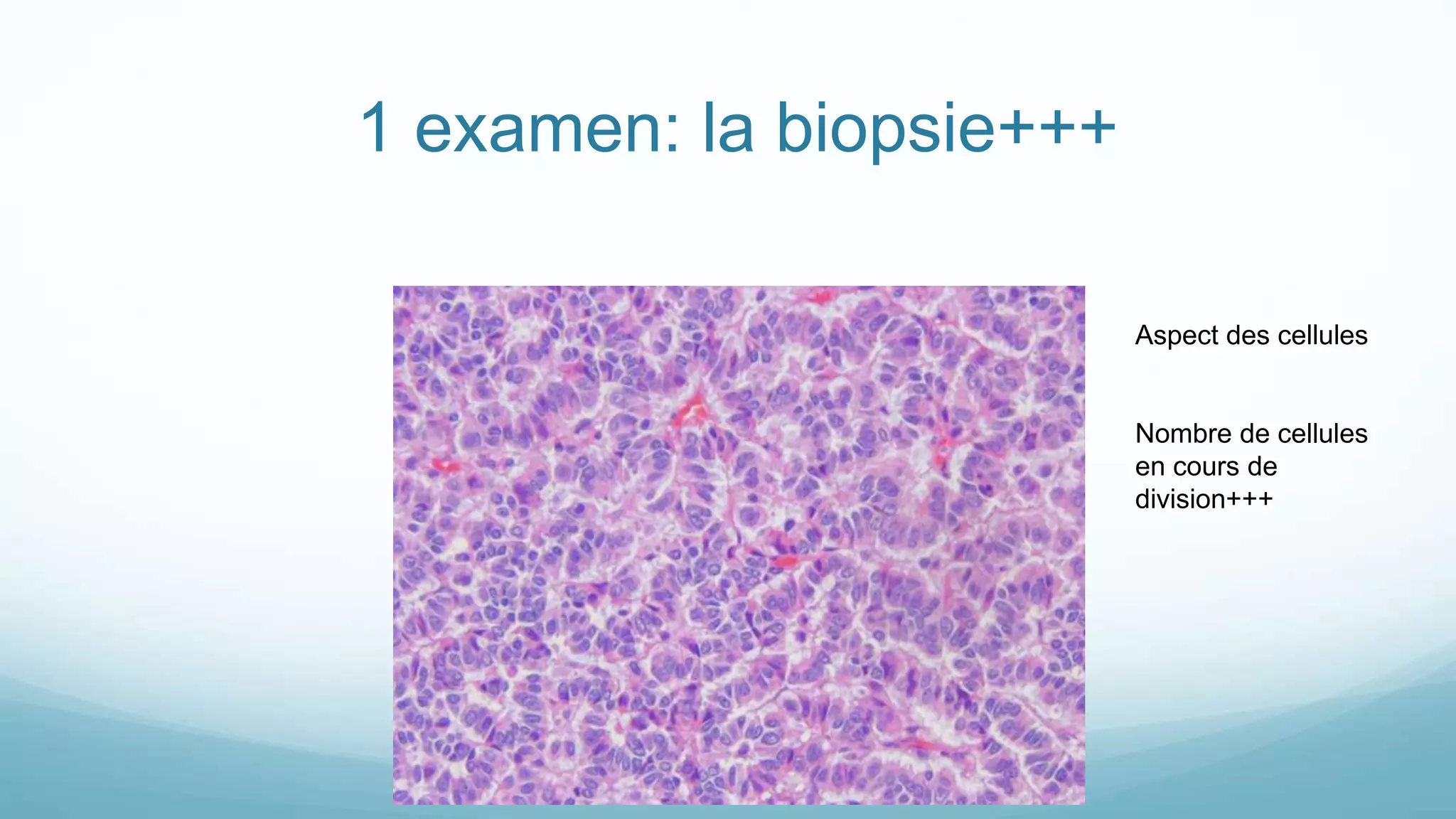 1 examen: la biopsie+++
Aspect des cellules
Nombre de cellules
en cours de
division+++
 