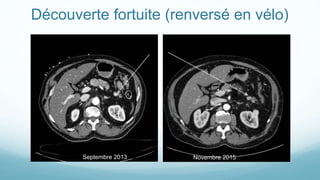 Découverte fortuite (renversé en vélo)
Septembre 2013 Novembre 2015
 