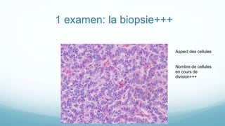 1 examen: la biopsie+++
Aspect des cellules
Nombre de cellules
en cours de
division+++
 