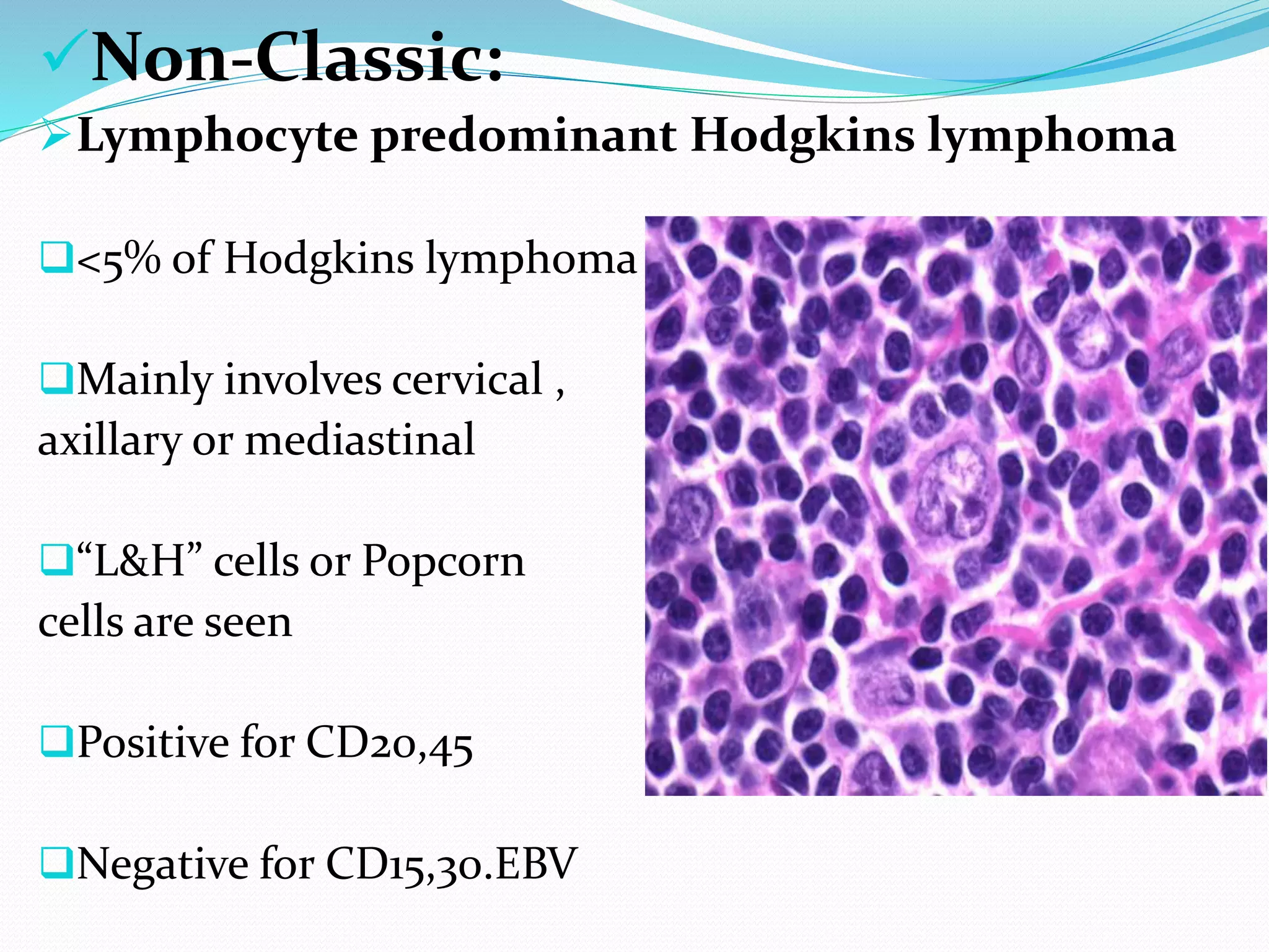 hodgkins lymphoma | PPTX