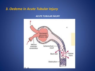 3. Oedema in Acute Tubular Injury
ACUTE TUBULAR INJURY
 