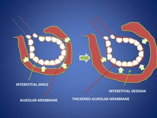 INTERSTITIAL SPACE
INTERSTITIAL OEDEMA
ALVEOLAR MEMBRANE THICKENED ALVEOLAR MEMBRANE
 