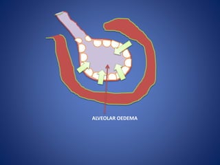 ALVEOLAR OEDEMA
 