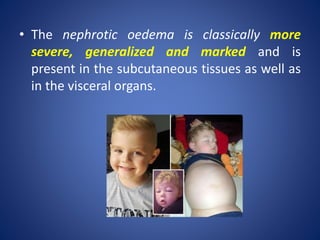 • The nephrotic oedema is classically more
severe, generalized and marked and is
present in the subcutaneous tissues as well as
in the visceral organs.
 