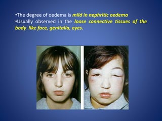 •The degree of oedema is mild in nephritic oedema
•Usually observed in the loose connective tissues of the
body like face, genitalia, eyes.
 