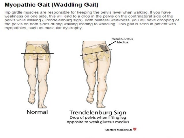 Walking disorders, muscle nerve interaction