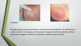 II stopień
Powiększające się zaczerwienienie, powierzchowna nadżerka. Po zakończeniu
ucisku rumień nie ustępuje, może pojawić się powierzchowny obrzęk, otarcie,
przerwanie ciągłości naskórka i pęcherze, zwykle towarzyszy ból
 
