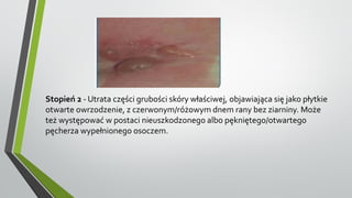 Stopień 2 - Utrata części grubości skóry właściwej, objawiająca się jako płytkie
otwarte owrzodzenie, z czerwonym/różowym dnem rany bez ziarniny. Może
też występować w postaci nieuszkodzonego albo pękniętego/otwartego
pęcherza wypełnionego osoczem.
 