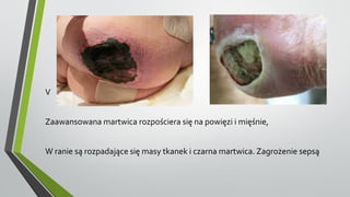 V
Zaawansowana martwica rozpościera się na powięzi i mięśnie,
W ranie są rozpadające się masy tkanek i czarna martwica. Zagrożenie sepsą
 