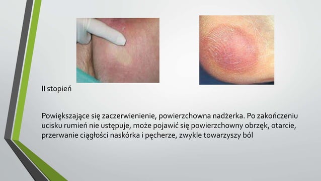 odlezyny-pptx-skin-and-dermatology-diseases-and-conditions