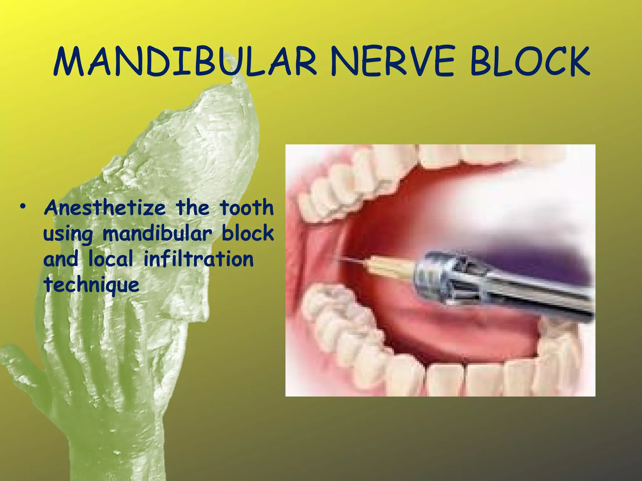 MANDIBULAR NERVE BLOCK
• Anesthetize the tooth
using mandibular block
and local infiltration
technique
 