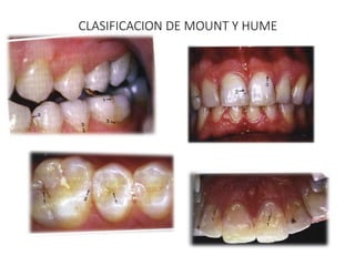 Mount Home Classification System odontodiagrama mecanica dental odontología | PDF