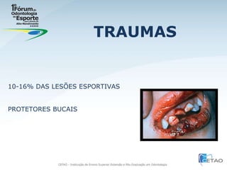 TRAUMAS 10-16% DAS LESÕES ESPORTIVAS PROTETORES BUCAIS 