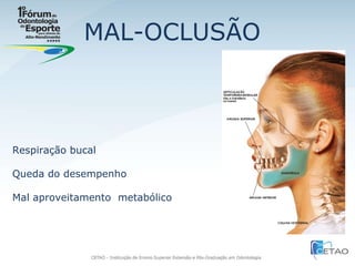 MAL-OCLUSÃO Respiração bucal Queda do desempenho Mal aproveitamento  metabólico 