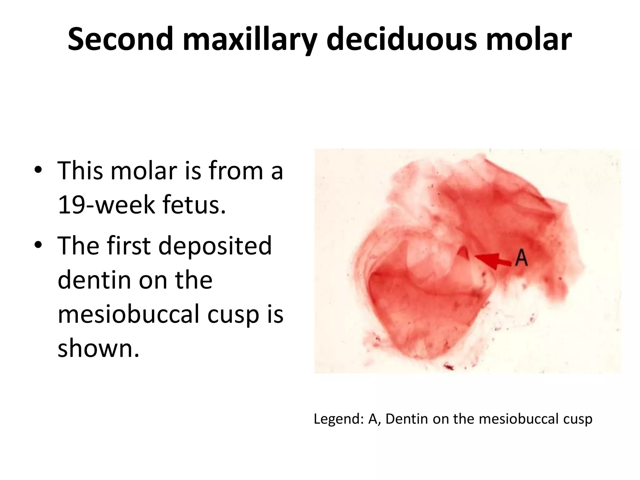 Second maxillary deciduous molar


• This molar is from a
  19-week fetus.
• The first deposited
  dentin on the
  mesiobuccal cusp is
  shown.

                         Legend: A, Dentin on the mesiobuccal cusp
 