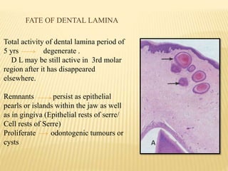 FATE OF DENTAL LAMINA
Total activity of dental lamina period of
5 yrs degenerate .
D L may be still active in 3rd molar
region after it has disappeared
elsewhere.
Remnants persist as epithelial
pearls or islands within the jaw as well
as in gingiva (Epithelial rests of serre/
Cell rests of Serre)
Proliferate odontogenic tumours or
cysts
 