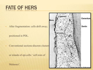 FATE OF HERS
 After fragmentation: cells drift away;
positioned in PDL.
 Conventional sections-discrete clusters
or islands of epi.cells: ‘cell rests of
Malassez’.
 