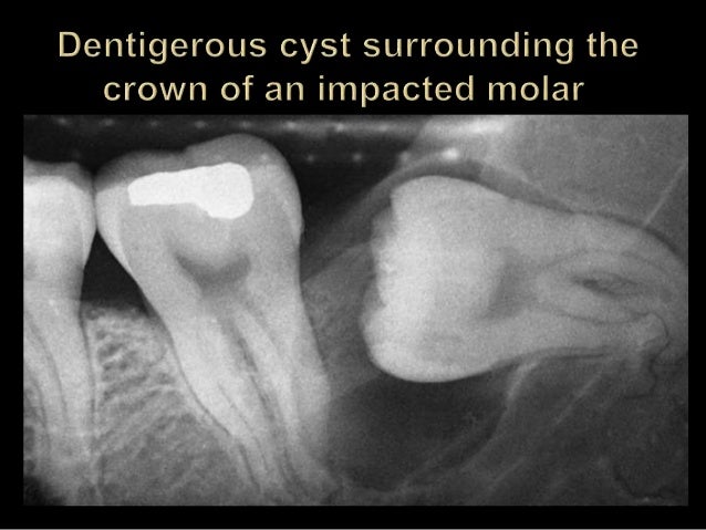 odontogenic cyst dina patho odontogenic cyst