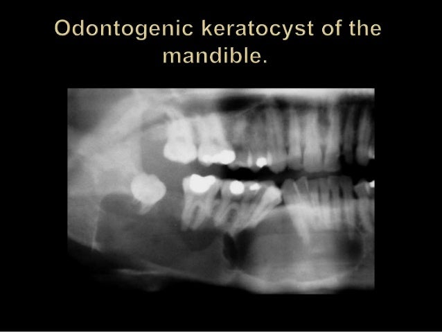 Odontogenic cyst dina patho