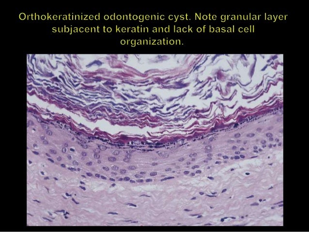 Odontogenic cyst dina patho