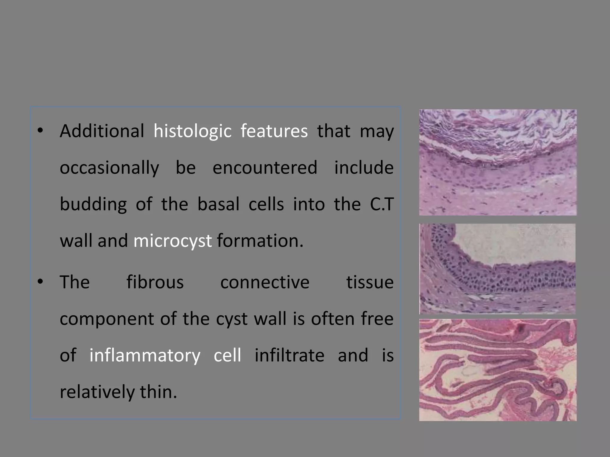 • Additional histologic features that may
occasionally be encountered include
budding of the basal cells into the C.T
wall and microcyst formation.
• The fibrous connective tissue
component of the cyst wall is often free
of inflammatory cell infiltrate and is
relatively thin.
 