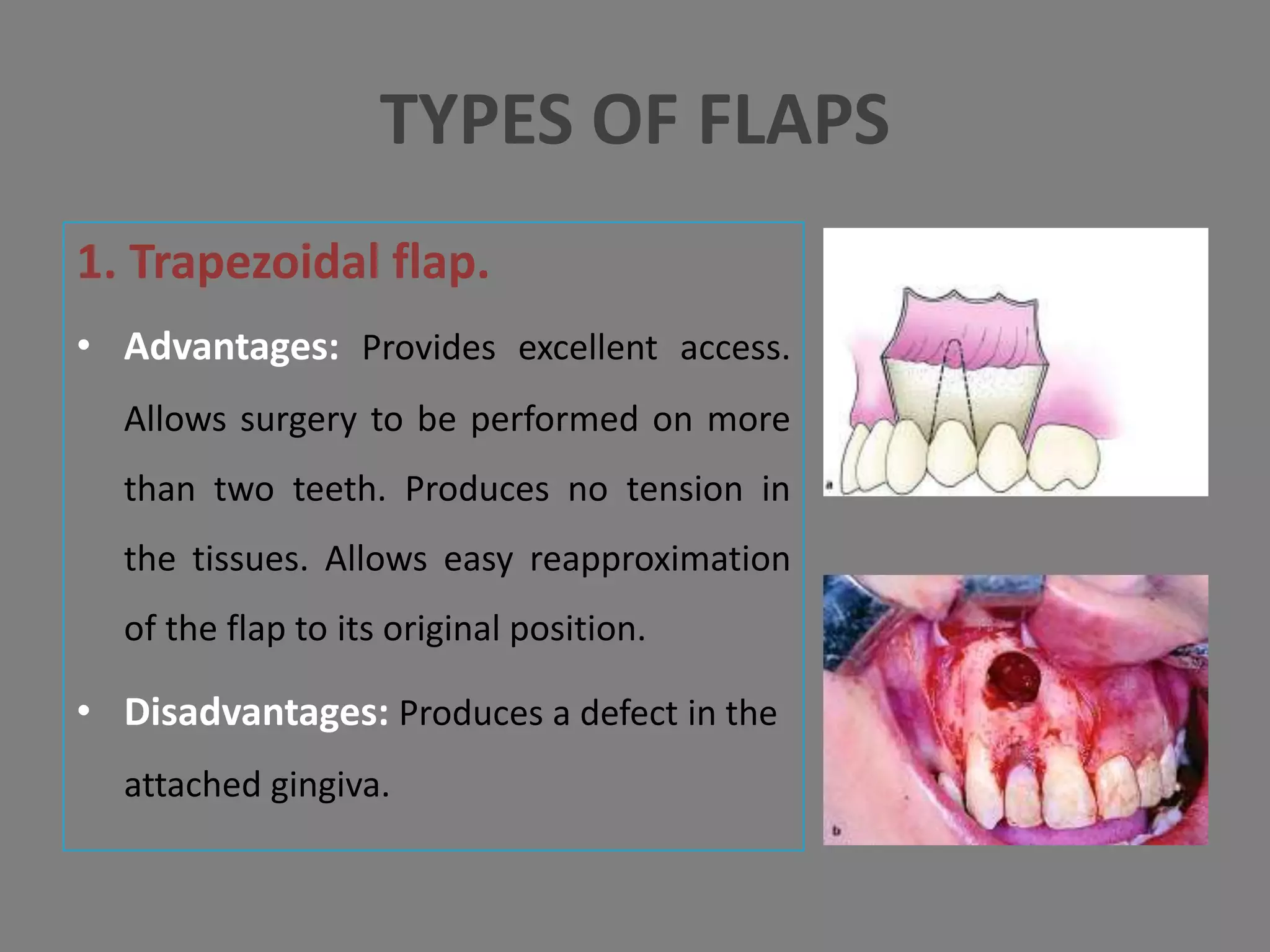 1. Trapezoidal flap.
• Advantages: Provides excellent access.
Allows surgery to be performed on more
than two teeth. Produces no tension in
the tissues. Allows easy reapproximation
of the flap to its original position.
• Disadvantages: Produces a defect in the
attached gingiva.
TYPES OF FLAPS
 