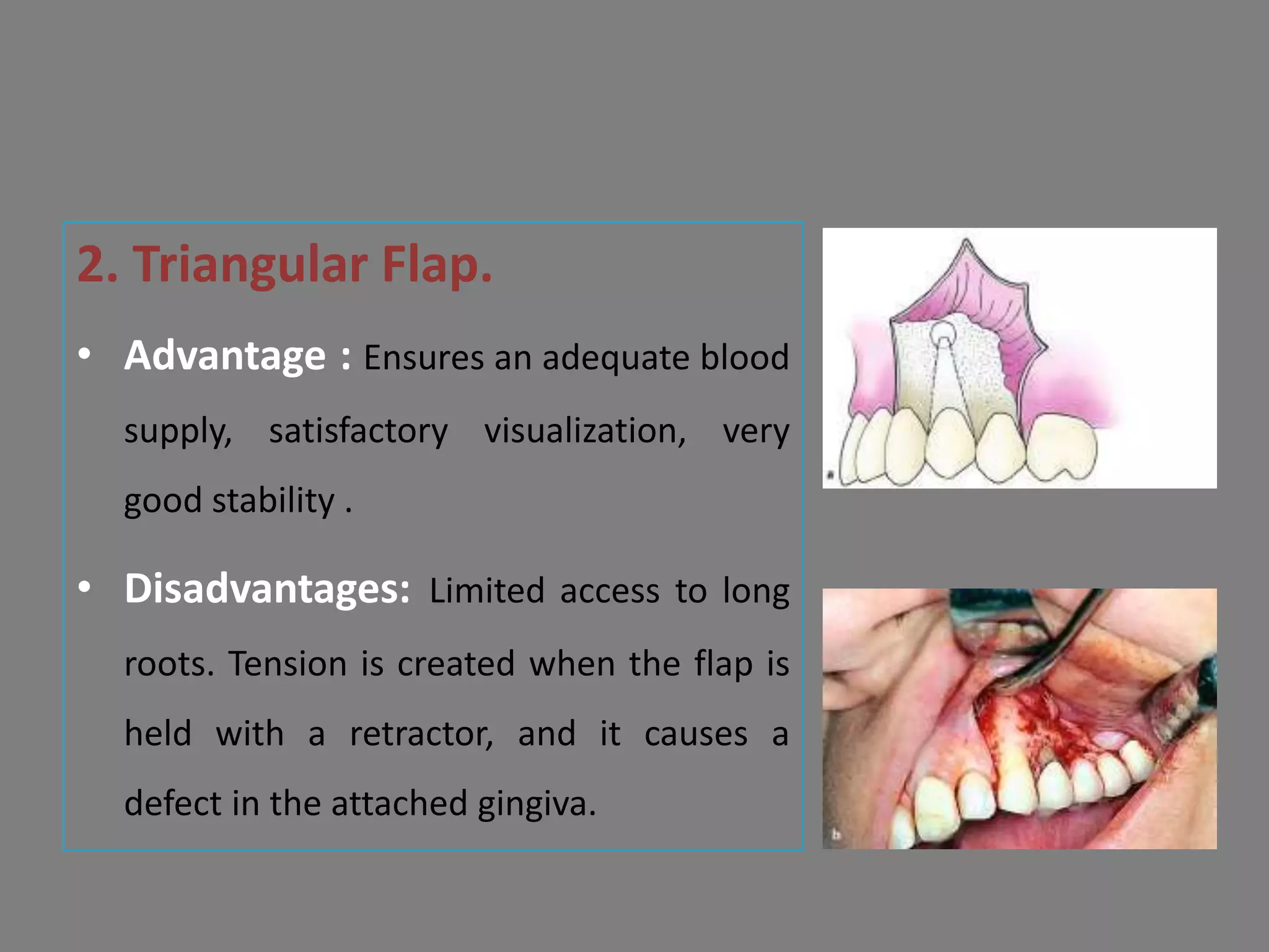 2. Triangular Flap.
• Advantage : Ensures an adequate blood
supply, satisfactory visualization, very
good stability .
• Disadvantages: Limited access to long
roots. Tension is created when the flap is
held with a retractor, and it causes a
defect in the attached gingiva.
 