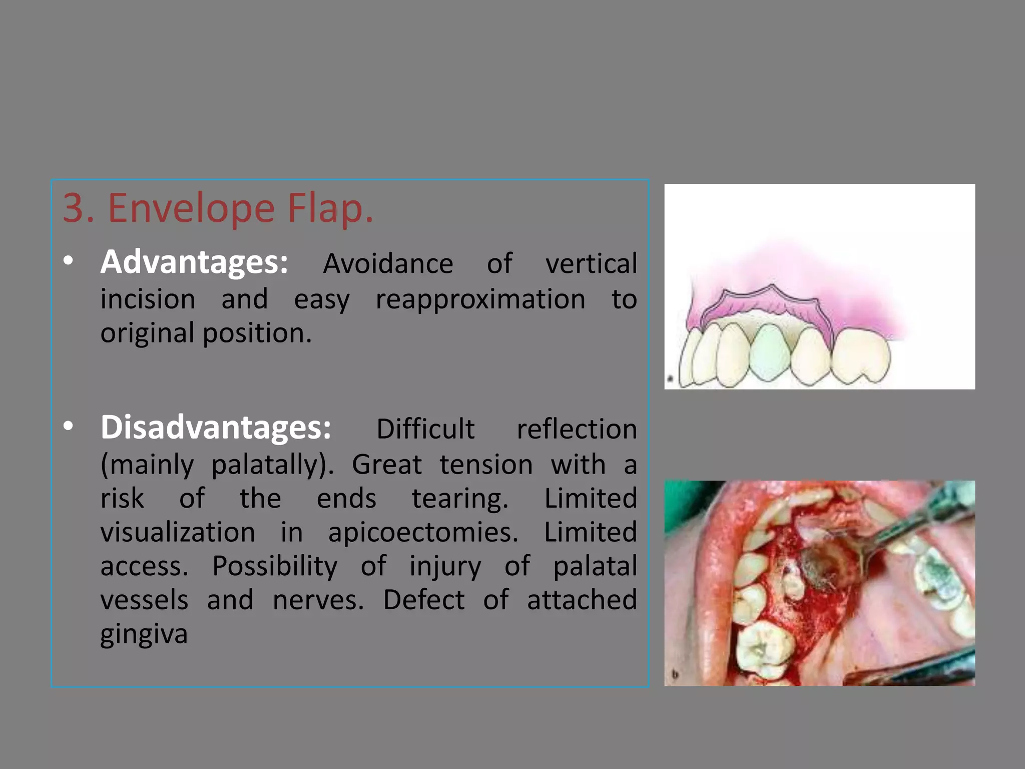 3. Envelope Flap.
• Advantages: Avoidance of vertical
incision and easy reapproximation to
original position.
• Disadvantages: Difficult reflection
(mainly palatally). Great tension with a
risk of the ends tearing. Limited
visualization in apicoectomies. Limited
access. Possibility of injury of palatal
vessels and nerves. Defect of attached
gingiva
 
