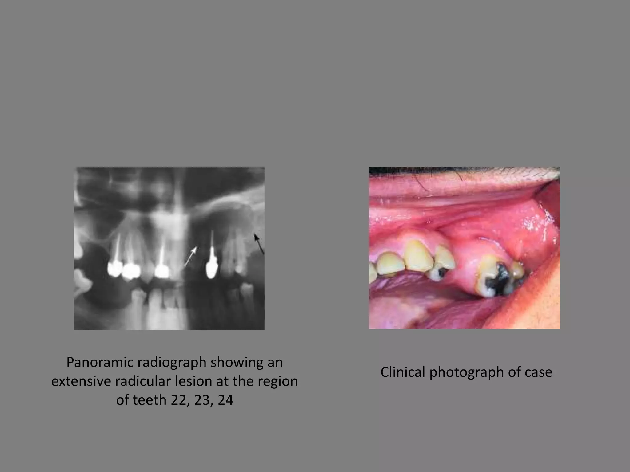 Panoramic radiograph showing an
extensive radicular lesion at the region
of teeth 22, 23, 24
Clinical photograph of case
 