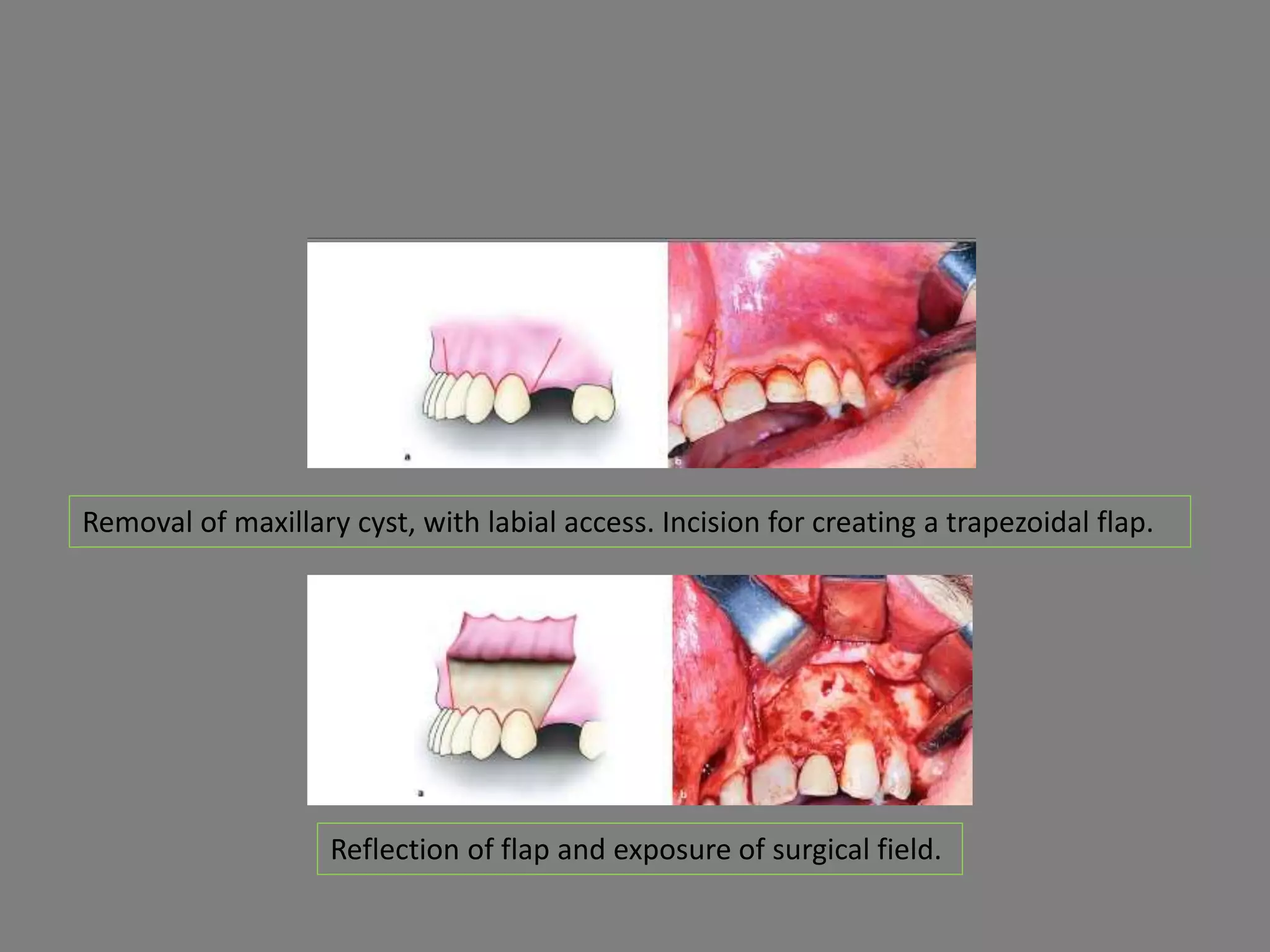 Removal of maxillary cyst, with labial access. Incision for creating a trapezoidal flap.
Reflection of flap and exposure of surgical field.
 