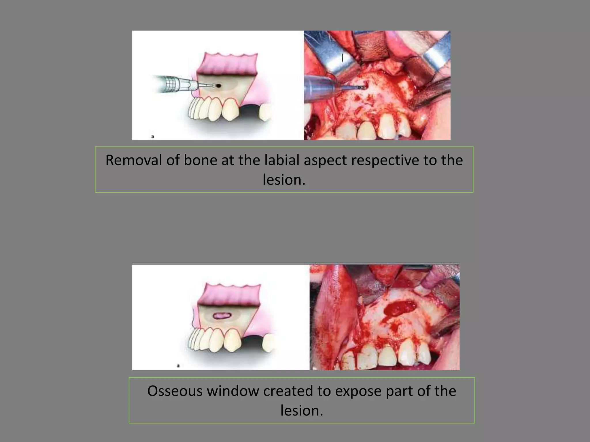 Removal of bone at the labial aspect respective to the
lesion.
Osseous window created to expose part of the
lesion.
 