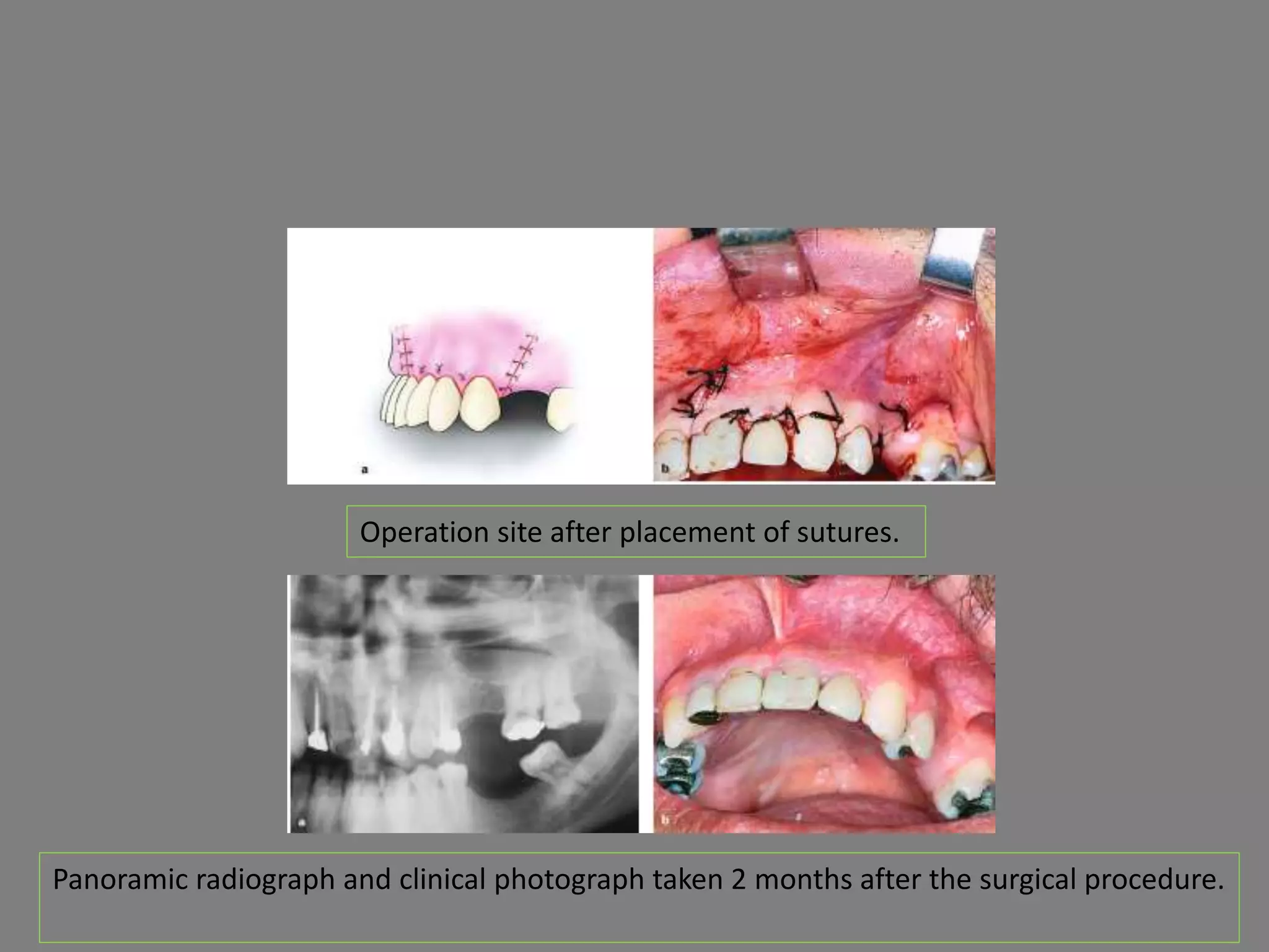 Operation site after placement of sutures.
Panoramic radiograph and clinical photograph taken 2 months after the surgical procedure.
 