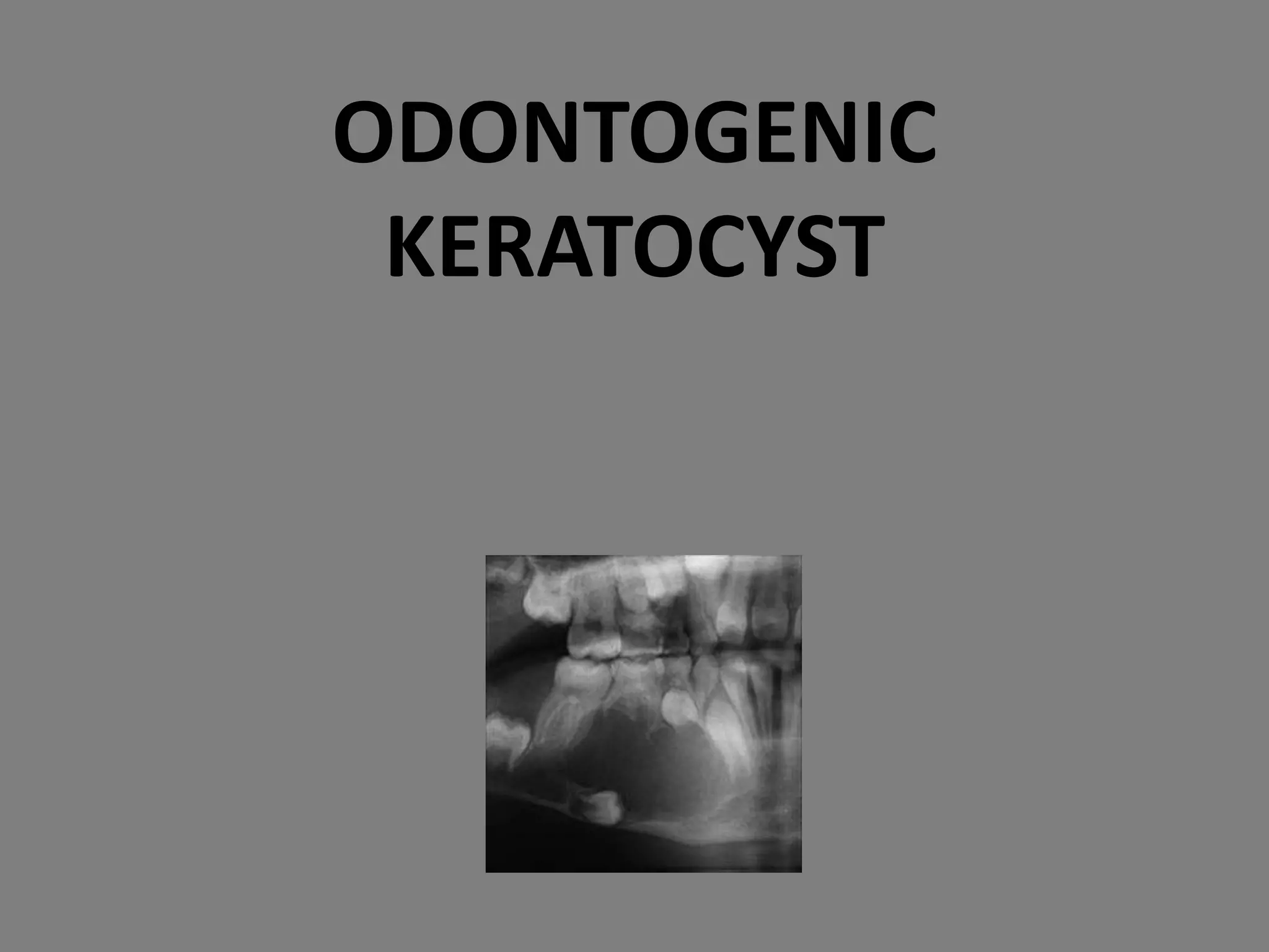 ODONTOGENIC
KERATOCYST
 
