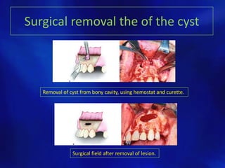 Surgical removal the of the cyst
Removal of cyst from bony cavity, using hemostat and curette.
Surgical field after removal of lesion.
 