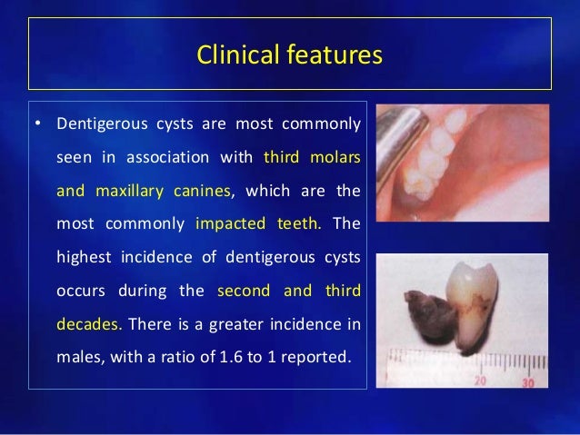 Odontogenic cysts