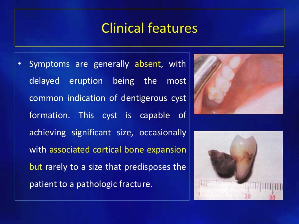 Odontogenic cysts