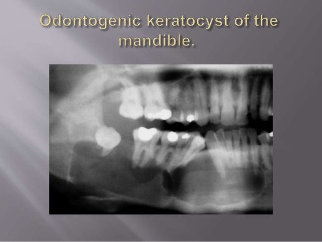odontogenic cysts odontogenic keratocyst